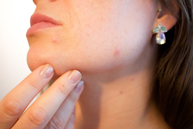 15 Natural Remedies For Pimples